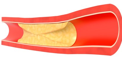 Periphere arterielle Verschlusskrankheit (PAVK)