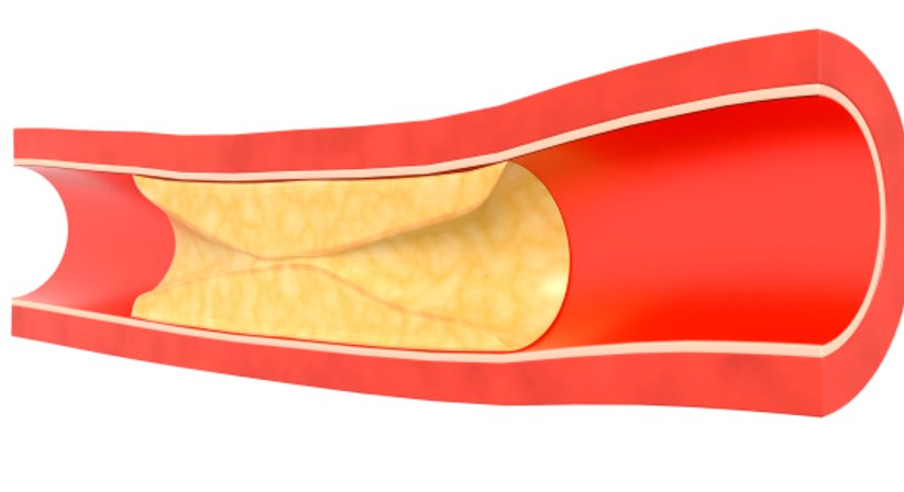 Periphere arterielle Verschlusskrankheit (PAVK) - Assoc. Prof. Priv. Doz. Dr. Markus Klinger FEBVS - Gefäßchirurg Wien 1190