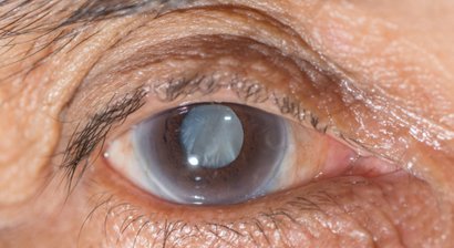 Grauer Star (Kataraktoperation)