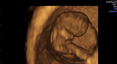 2D, 3D, 4D Ultraschall