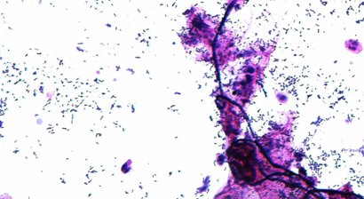 Betreuung von chronischen Infektionen