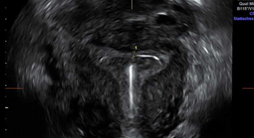 Familienplanung/Verhütung - Univ.Prof. Dr. Armin Witt - Frauenarzt Wien 1090