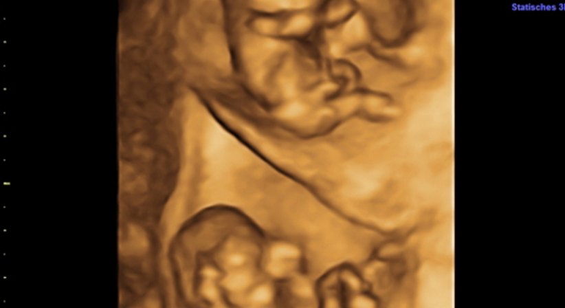 Zwillinge und mehr - Univ.Prof. Dr. Armin Witt - Frauenarzt Wien 1090