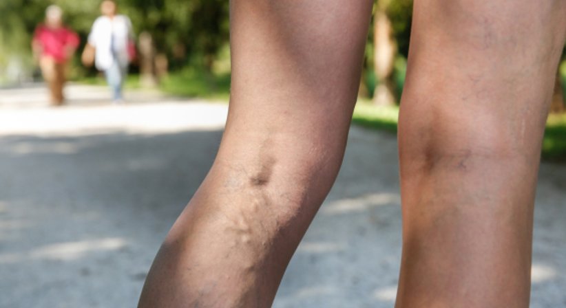 Krampfadern - OA Dr. Alexander Butz - Allgemeinchirurg Wien 1130