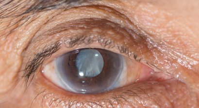 Grauer Star (Kataraktoperation)