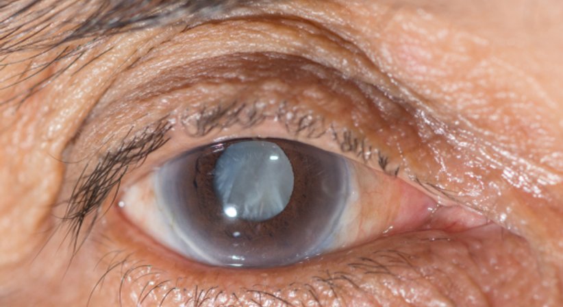 Grauer Star (Kataraktoperation) - Univ.- Doz. Dr. Guido Dorner - Augenarzt Wien 1130