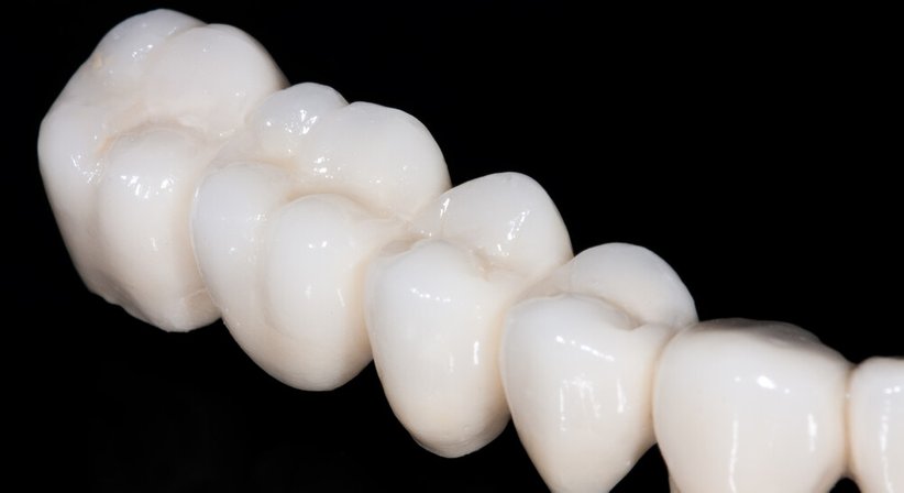  Keramikkronen und –brücken - DDr. Akos Feher - Zahnarzt Wien 1010