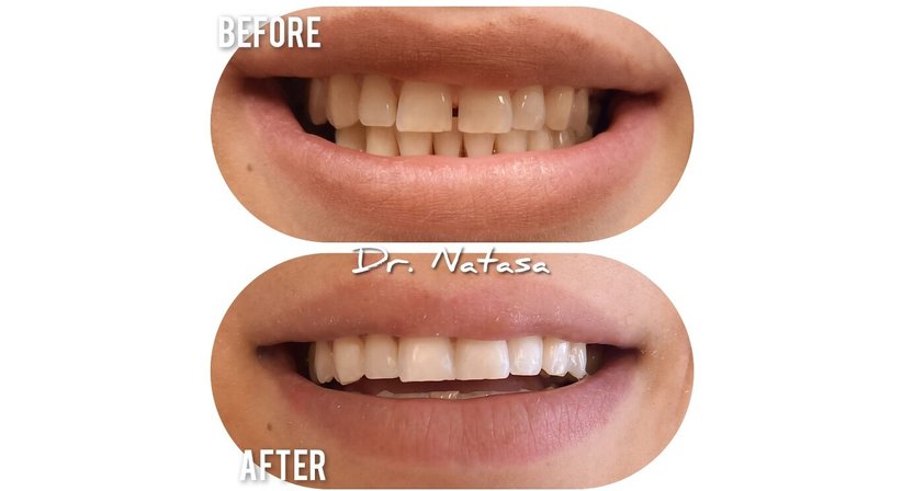 Professionelle Zahnreinigung / Bleaching - Medic dent. Natasa Vukajlovic - Zahnärztin Wien 1230