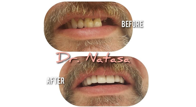 Brücke - Medic dent. Natasa Vukajlovic - Zahnärztin Wien 1230