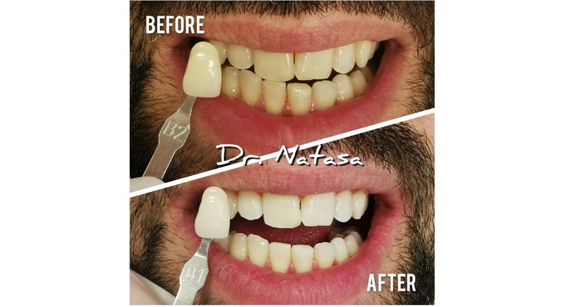 Professionelle Zahnreinigung / Bleaching - Medic dent. Natasa Vukajlovic - Zahnärztin Wien 1230