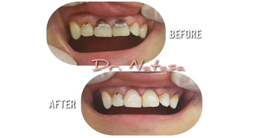 Zahnfüllungen - Medic dent. Natasa Vukajlovic - Zahnärztin Wien 1230