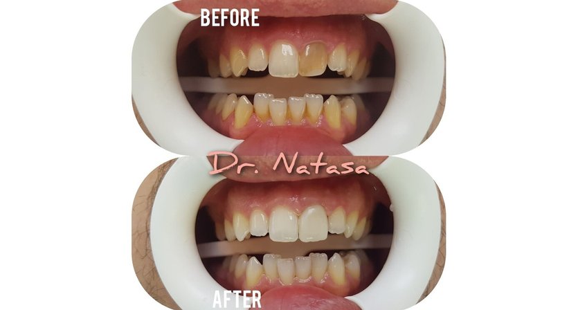 Professionelle Zahnreinigung / Bleaching - Medic dent. Natasa Vukajlovic - Zahnärztin Wien 1230