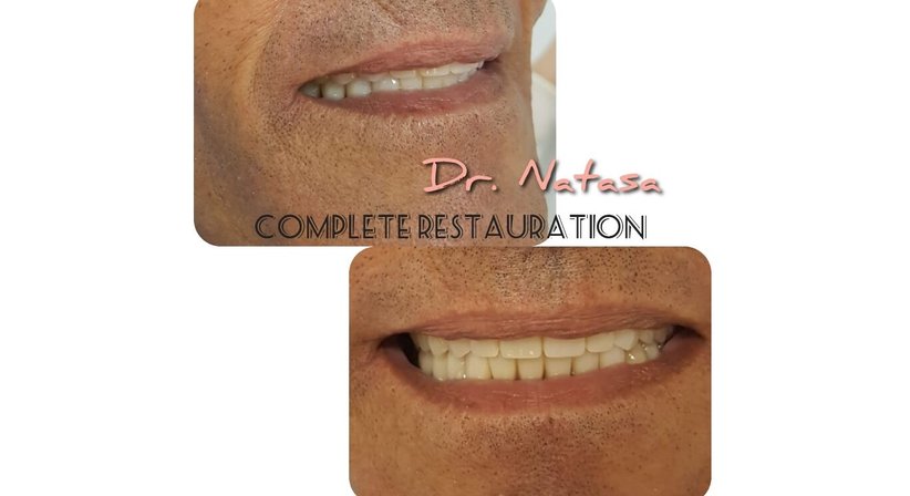 Prothesen - Medic dent. Natasa Vukajlovic - Zahnärztin Wien 1230