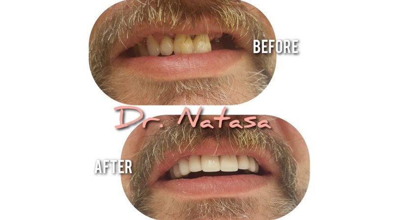 Krone - Medic dent. Natasa Vukajlovic - Zahnärztin Wien 1230