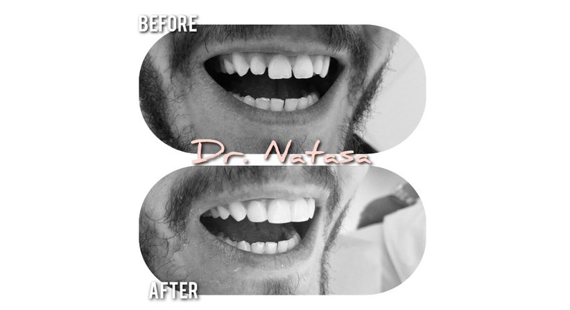 Veneers - Medic dent. Natasa Vukajlovic - Zahnärztin Wien 1230