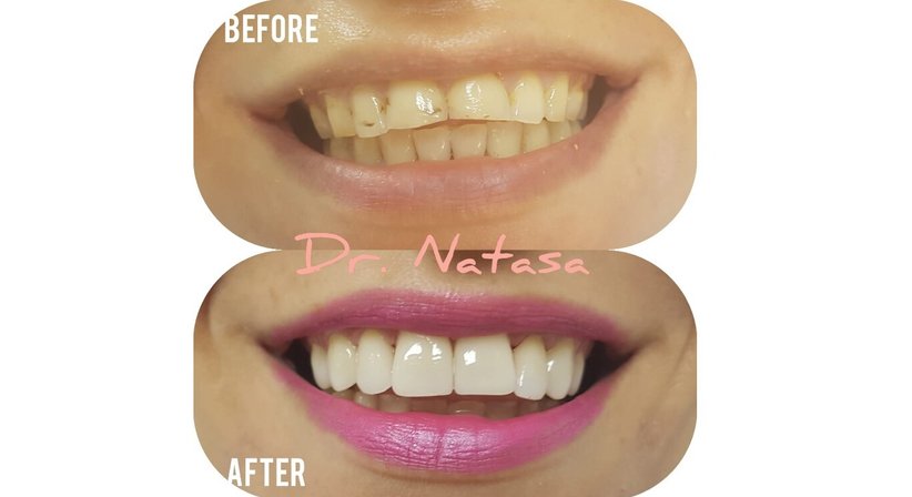 Krone - Medic dent. Natasa Vukajlovic - Zahnärztin Wien 1230