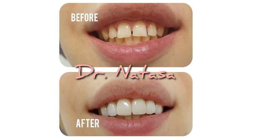 Veneers - Medic dent. Natasa Vukajlovic - Zahnärztin Wien 1230