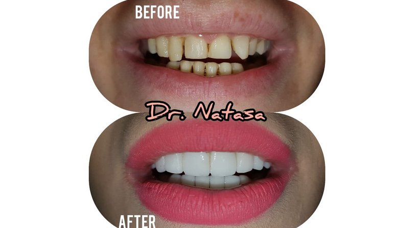 Veneers - Medic dent. Natasa Vukajlovic - Zahnärztin Wien 1230