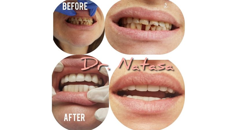 Veneers - Medic dent. Natasa Vukajlovic - Zahnärztin Wien 1230