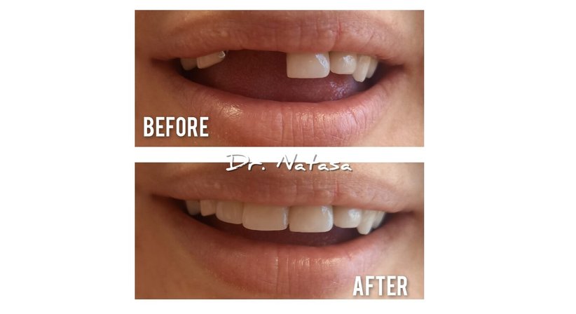 Brücke - Medic dent. Natasa Vukajlovic - Zahnärztin Wien 1230