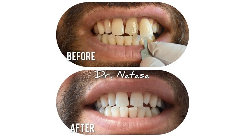 Professionelle Zahnreinigung / Bleaching - Medic dent. Natasa Vukajlovic - Zahnärztin Wien 1230