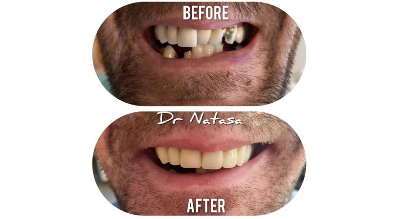 Prothesen - Medic dent. Natasa Vukajlovic - Zahnärztin Wien 1230