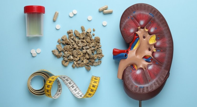 Nieren- und Harnleitersteine - Priv. Doz. Dr. Sabina Sevcenco - Urologin Wien 1090