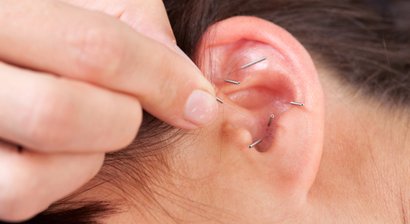 Ohrakupunktur