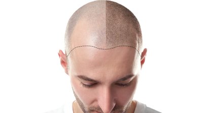 Eigenhaartransplantation