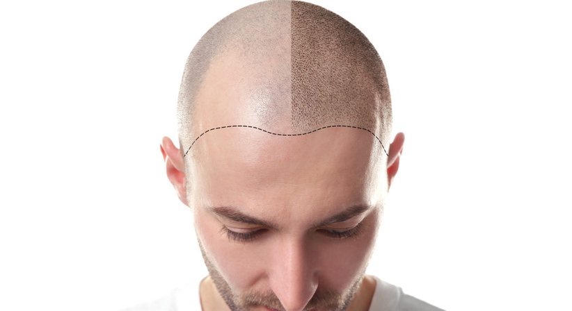 Eigenhaartransplantation - Dr. Rajmond Pikula - Plastischer Chirurg Götzis 6840