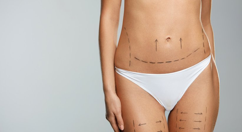 Fettabsaugung - Dr. Rajmond Pikula - Plastischer Chirurg Götzis 6840