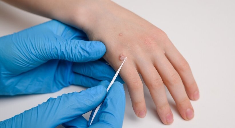 Chirurgische Entfernung von unerwünschten, gutartigen Hautveränderungen (Alterswarzen, Warzen, Altersflecken, Angiome, Lipome, Dermatofibrome) - Dr. Biljana Schuller-Lukic - Hautärztin Wien 1080