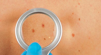 Hautkrebsvorsorge (Muttermalkontrolle)