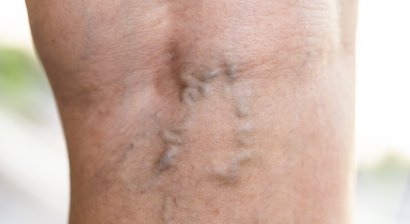 Krampfaderbehandlung (Katheter-Operation und ultraschallgezielte Schaumverödung)