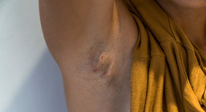 Akne inversa Operationen