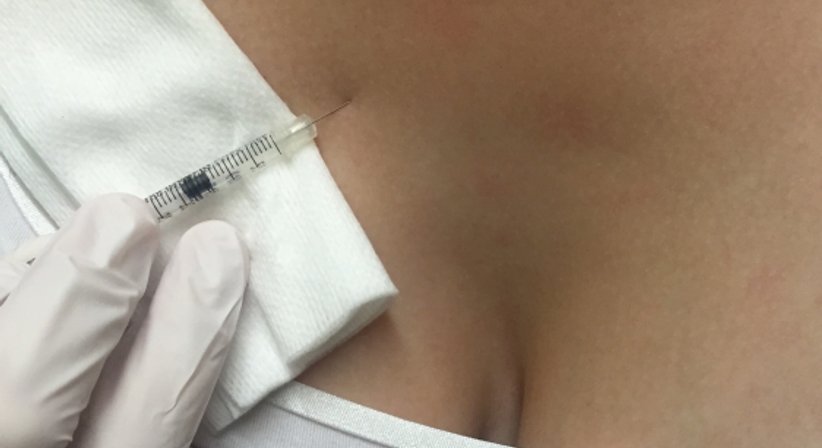Ästhetische Mesotherapie - Dr. Andrea Luidold - Praktische Ärztin Leibnitz 8430