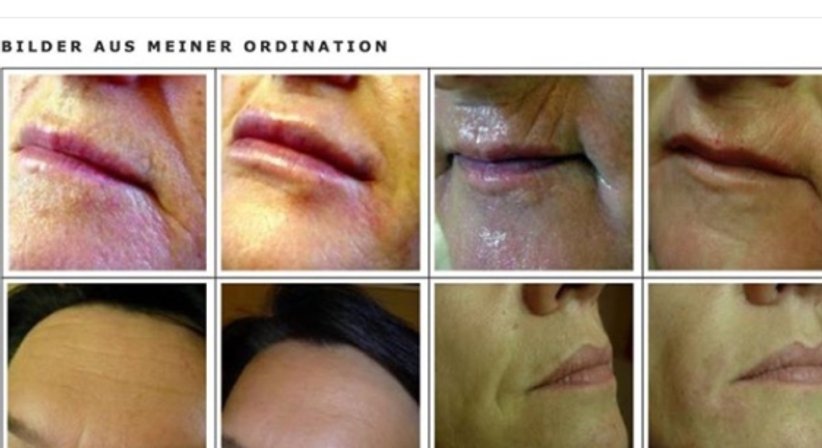 Faltenunterspritzung mit Hyaluronsäure - Dr. Andrea Luidold - Praktische Ärztin Leibnitz 8430