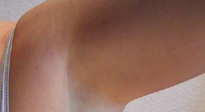 Hyperhidrose: Behandlung von übermäßigem Schwitzen mit Botox - Dr. Andrea Luidold - Praktische Ärztin Leibnitz 8430