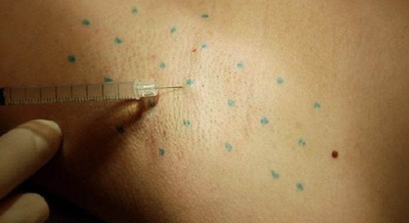 Hyperhidrose: Behandlung von übermäßigem Schwitzen mit Botox - Dr. Andrea Luidold - Praktische Ärztin Leibnitz 8430