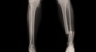 Unterschenkel Marknagel