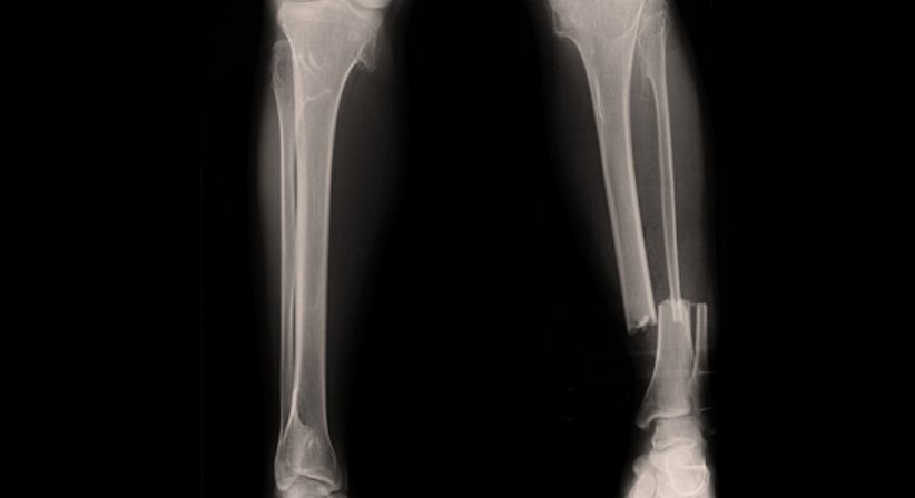 Unterschenkel Marknagel - Prim. Dr. Wolfgang Kaltenbrunner - Orthopäde Korneuburg 2100