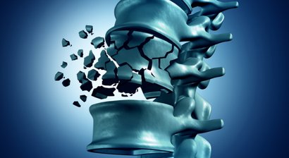 Vertebroplastie/ Kyphoplastie