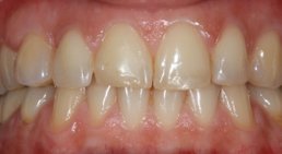 Aesthetische Zahnheilkunde - Veneers -