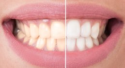 Bleaching -