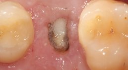 Implantologie, All-on-6 Konzept, Computernavigierte Implantation (3D) -