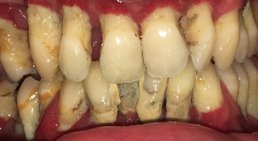 Prophylaxe (professionelle Mundhygiene) -