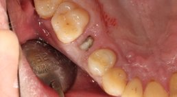 Sofortbelastende Implantologie -