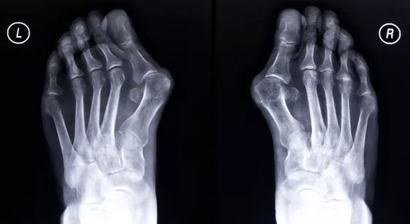 Hallux valgus