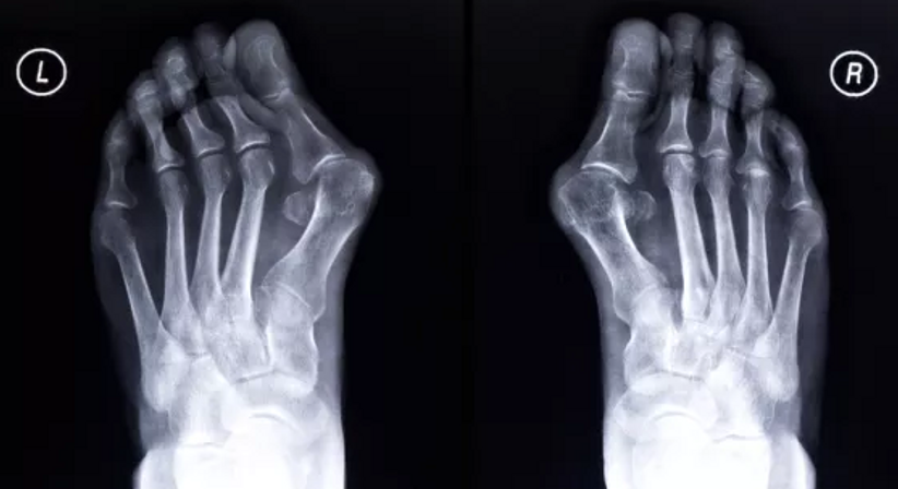 Hallux valgus - Dr. Omar El-Shohoumi - Orthopäde Stockerau 2000