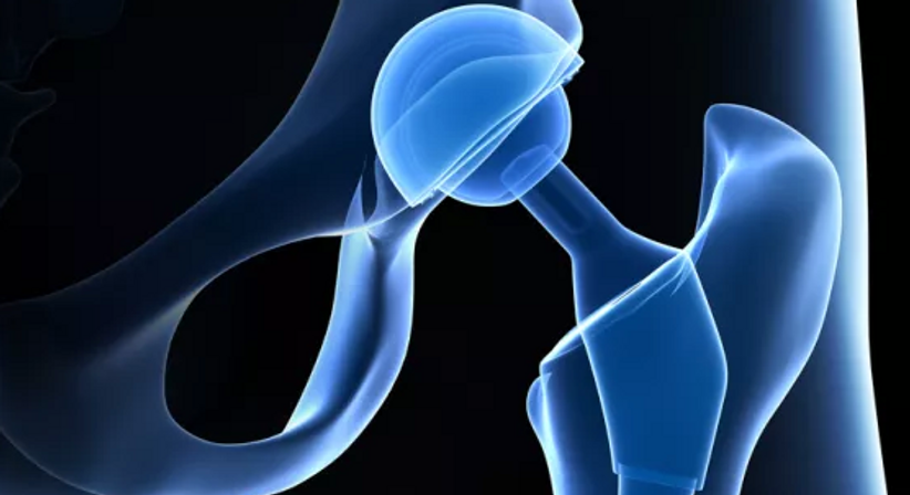 Hüftprothese - Dr. Omar El-Shohoumi - Orthopäde Stockerau 2000